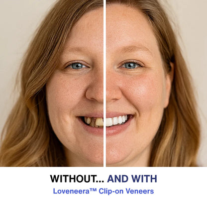 Loveneera™ Clip-on Veneers