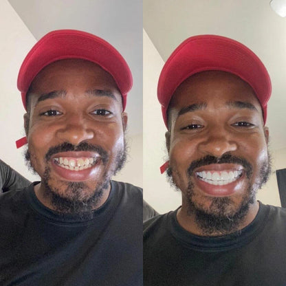 Vaneero Clip-on Veneers